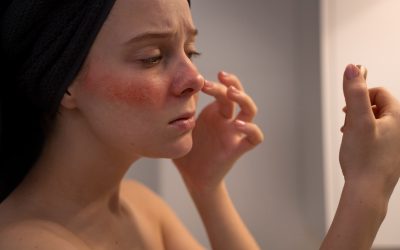 Kako prepoznati i liječiti kožne alergijske reakcije?